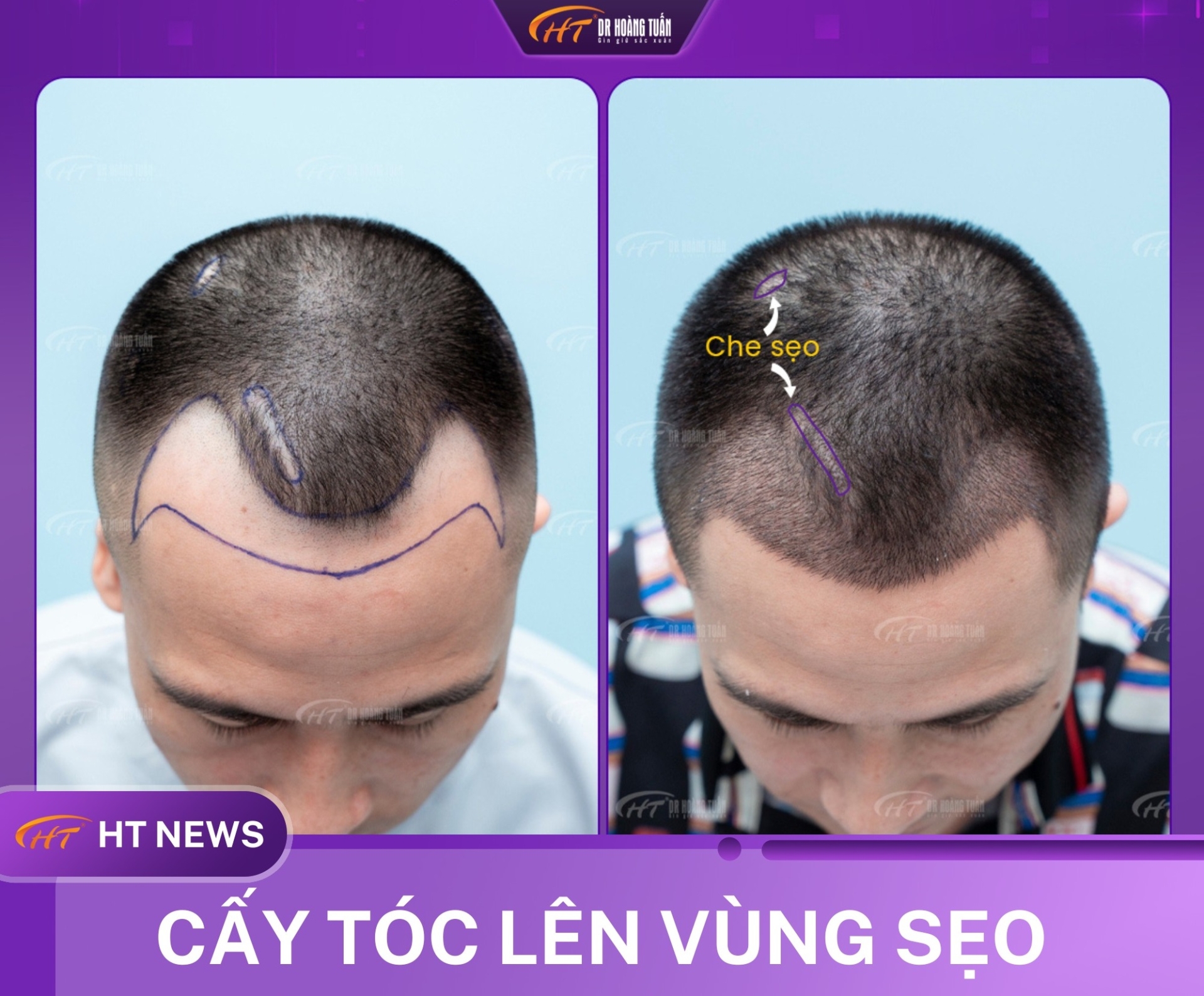 h&oacute;i chữ m n&ecirc;n để t&oacute;c g&igrave;